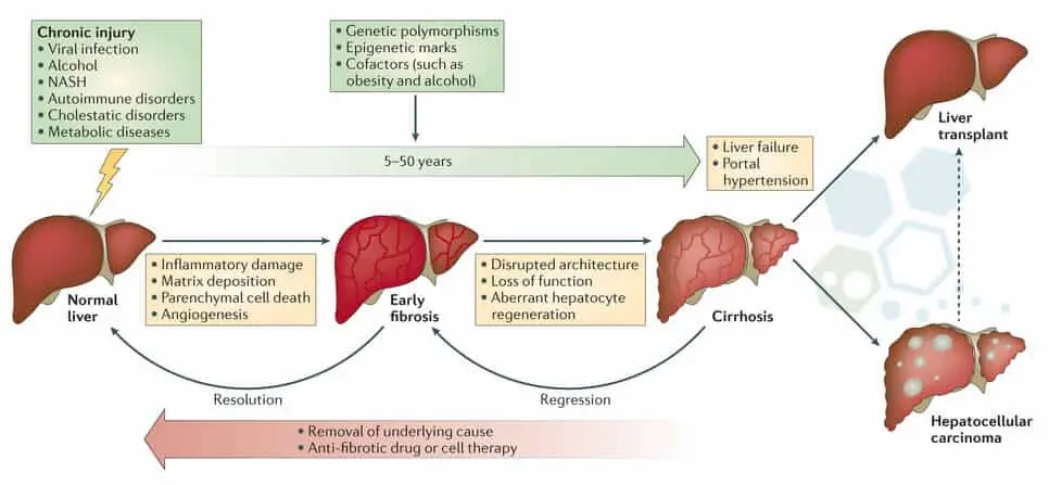 Un graphique montrant l'évolution des patients avant et après le traitement par cellules souches pour les maladies du foie