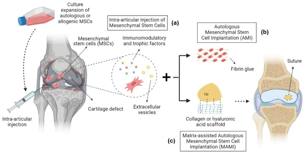 thérapie par cellules souches pour les blessures du genou