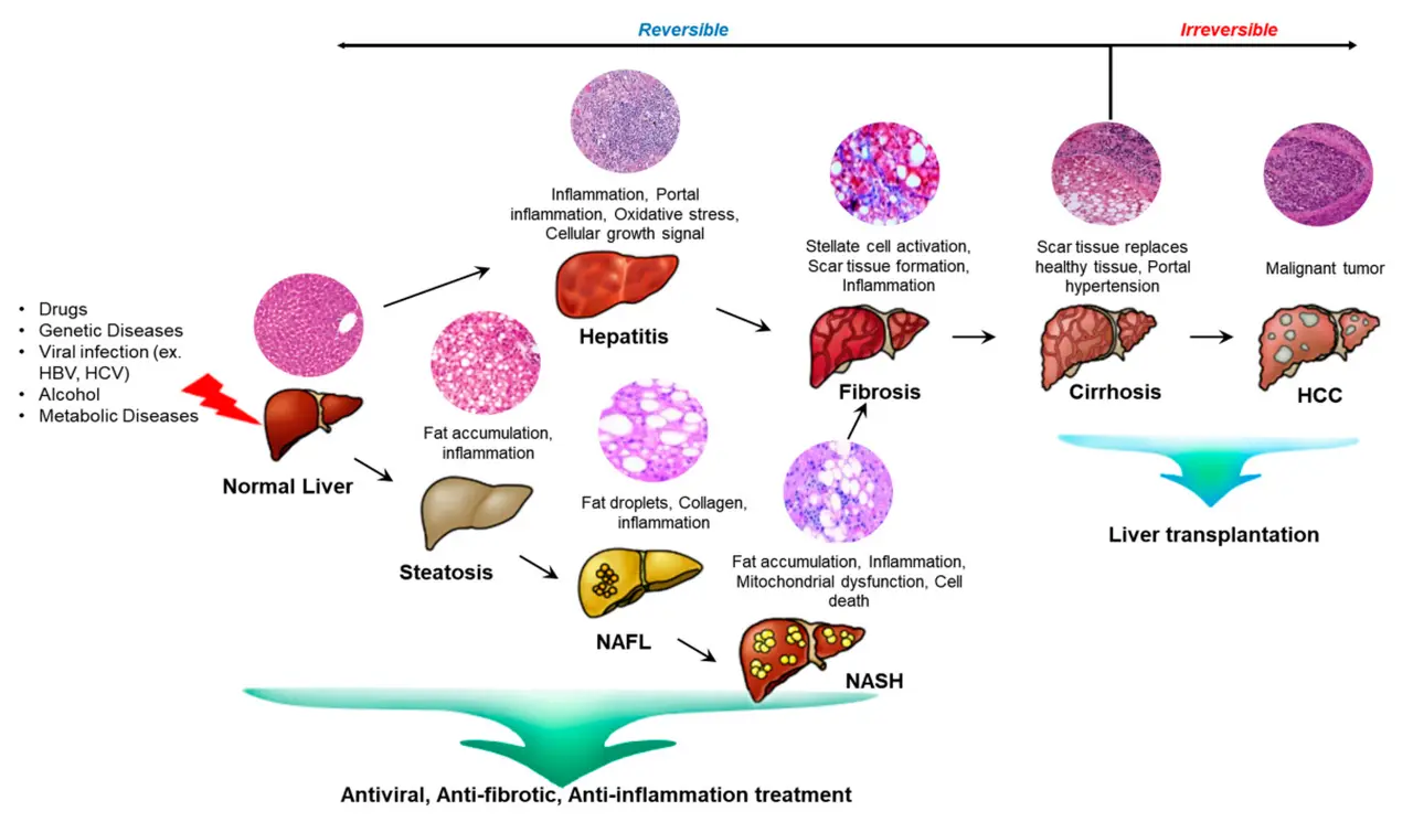 Une infographie illustrant le fonctionnement du traitement par cellules souches dans les maladies du foie