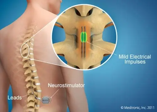 Stimulation Epidurale