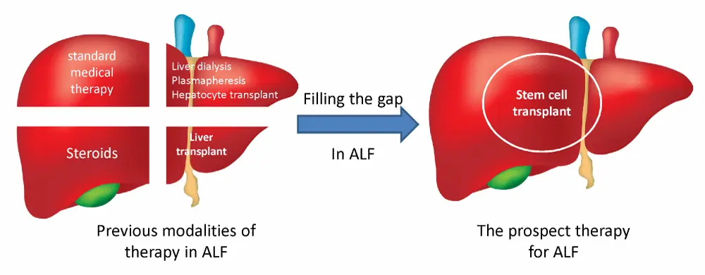 Une image futuriste illustrant le potentiel du traitement par cellules souches pour les maladies du foie