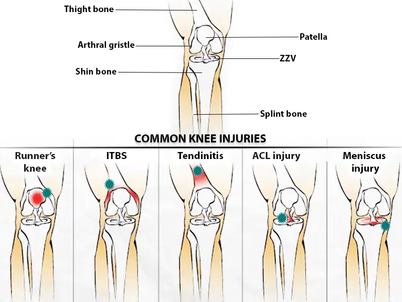 Types courants de blessures du genou
