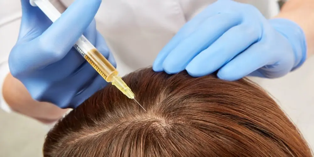 injection de cellules souches dans le cuir chevelu.