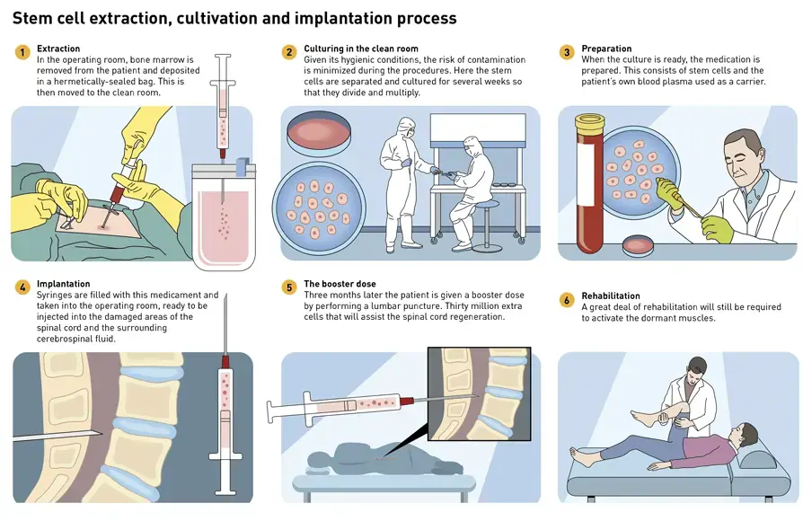 processus du traitement par cellules souches d'une blessure du genou